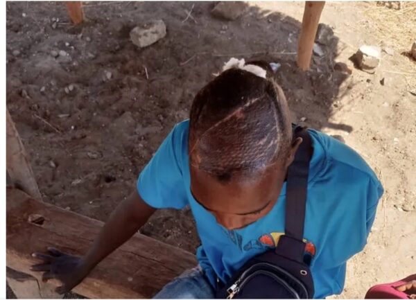 Kudzai Masauso Worker amputated Kudzai Masauso